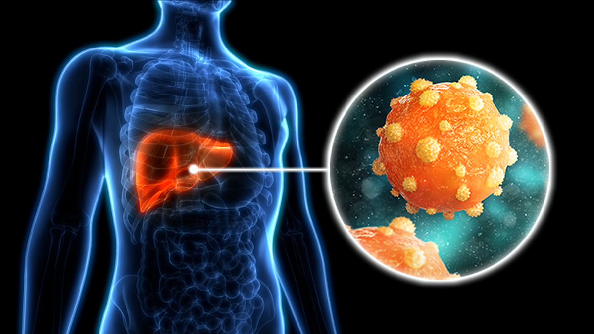 Hepatitis B Overview Thumbnail An illustration showing the hepatitis b virus in the liver